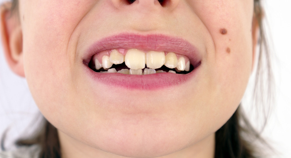A person smiling to show their overbite